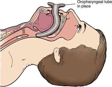 Emergency Oral Airway Kit Line2Design 